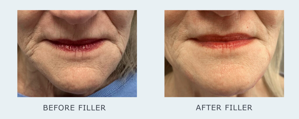 Before and After results Montage Filler MC Modern Skin