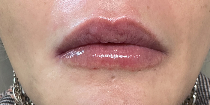 after lipfiller_McModernskin_Cr2501_4859.jpg