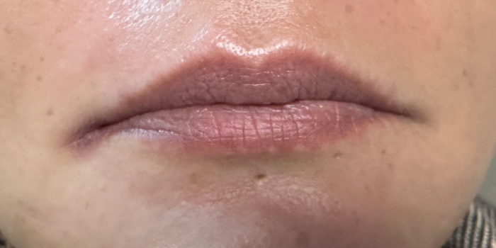 before lipfiller_McModernskin_Cr2501_4857